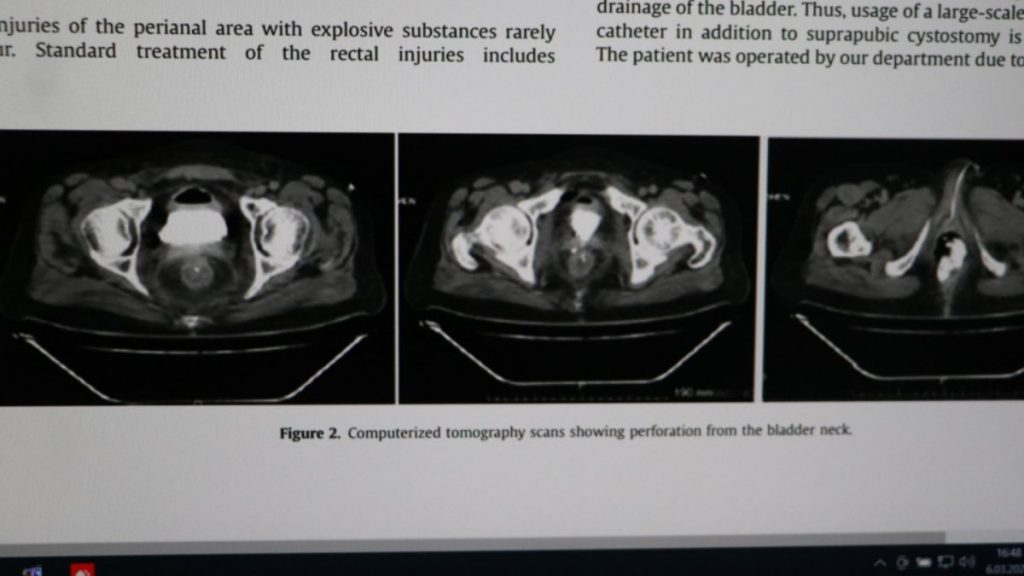 Denizli’de makatına torpil yerleştirip patlatan kişi, tıp literatürüne girdi