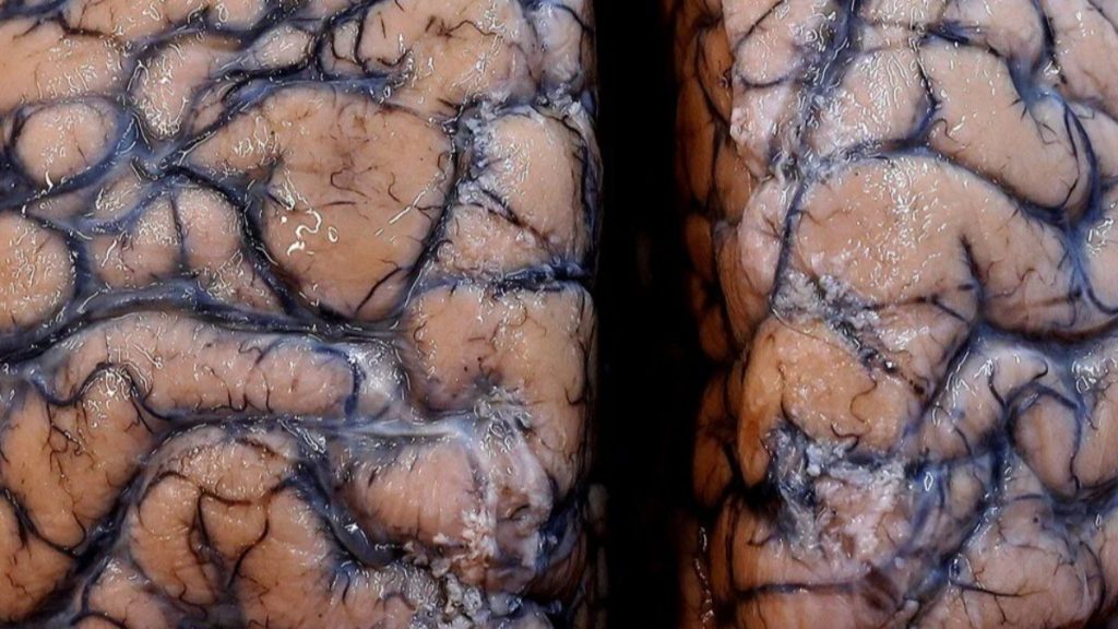 Ne korona, ne omicron! Beyni iltihaplandıran yeni virüsün adı…